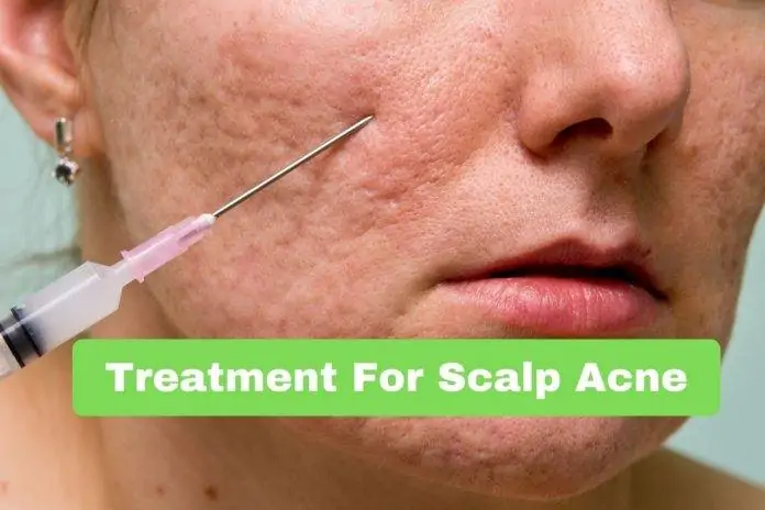 Treatment For Scalp Acne