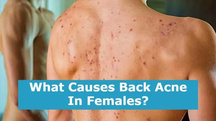 What Causes Back Acne In Females?