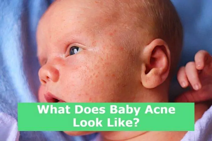 What Does Baby Acne Look Like?