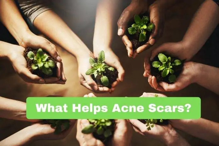 What Helps Acne Scars?