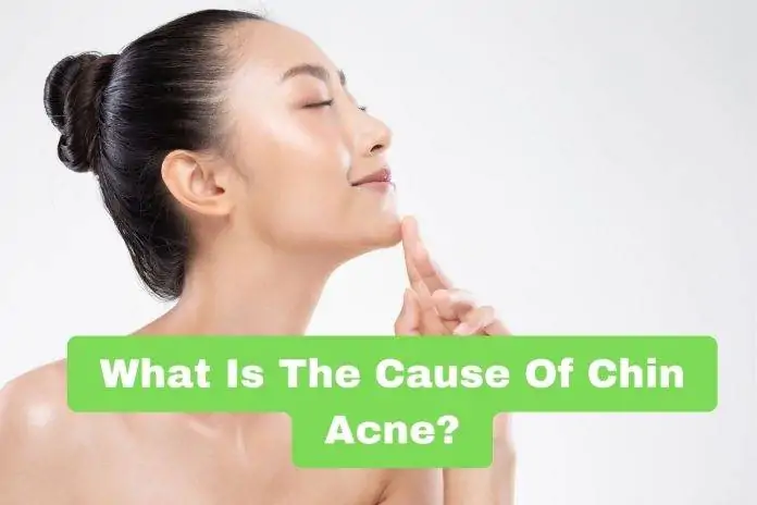 What Is The Cause Of Chin Acne?