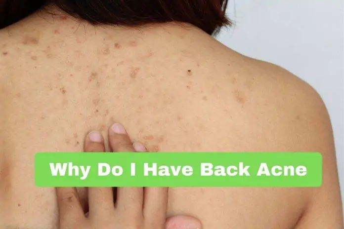 Why Do I Have Back Acne